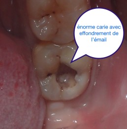 Dentisterie minimale invasive