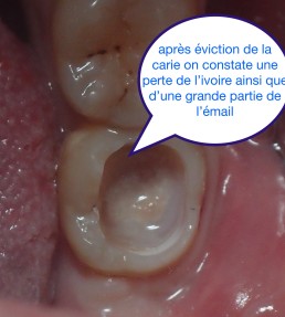 Dentisterie minimale invasive