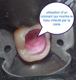 Dentisterie minimale invasive