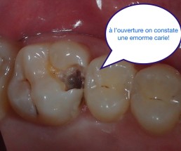 Dentisterie bio-consciente, éviter les couronnes le plus possibles.