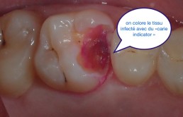 Dentisterie bio-consciente, éviter les couronnes le plus possibles.