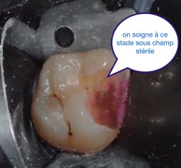 Dentisterie bio-consciente, éviter les couronnes le plus possibles.