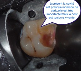 Dentisterie bio-consciente, éviter les couronnes le plus possibles.