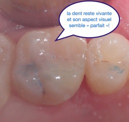 Dentisterie bio-consciente, éviter les couronnes le plus possibles.