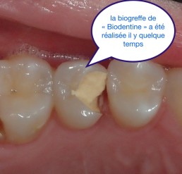 La Bio-greffe Bio-céramique