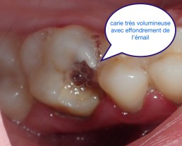 Garder les dents vivantes grâce aux biociments type 