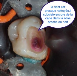 Garder les dents vivantes grâce aux biociments type 