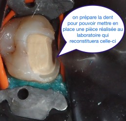 Garder les dents vivantes grâce aux biociments type 