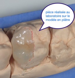 Garder les dents vivantes grâce aux biociments type 