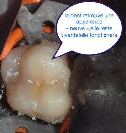 Garder les dents vivantes grâce aux biociments type 