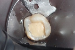 Dent préparée pour inlay