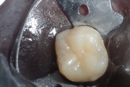 Inlay en place LA DENT RESTE VIVANTE