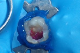 Colorant sélectif de la carie