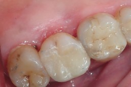 Dent avec carie interne profonde