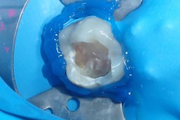 Lésion carieuse importante