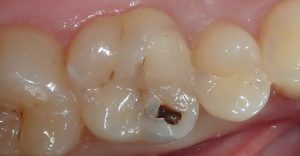 récidive de carie sous une résine ancienne