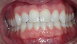 Blanchiement / Eclaircissement Dentaire